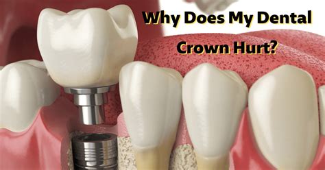 Aug 23, 2018 typical pain that MAY occur when placing a crown happens for maybe 10 minutes due to pressure on gum. . How long should a crown hurt reddit
